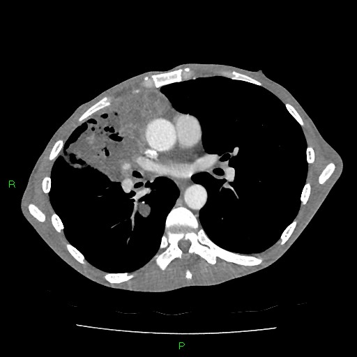 File:Acute right lung abscess (Radiopaedia 34806-36258 Axial C+ arterial phase 95).jpg