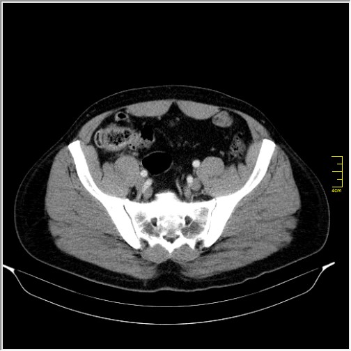 File:Acute right sided diverticulitis (Radiopaedia 65249-74268 Axial C+ portal venous phase 62).JPG