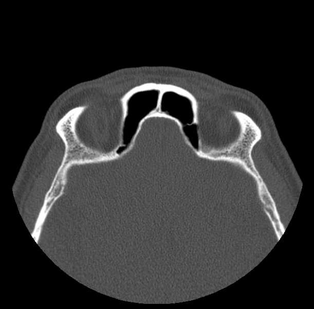 Acute sinusitis (Radiopaedia 23161-23215 Axial bone window 62).jpg