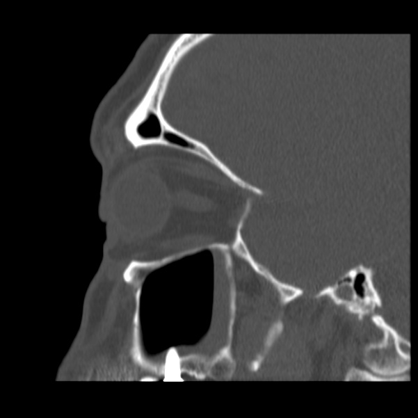 Acute sinusitis (Radiopaedia 23161-23215 Sagittal bone window 46).jpg