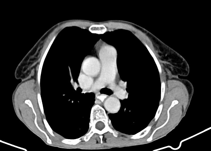 Acute small bowel (ileal) volvulus (Radiopaedia 71740-82139 Axial C+ portal venous phase 4).jpg