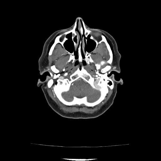 Acute subarachnoid hemorrhage and accessory anterior cerebral artery (Radiopaedia 69231-79009 Axial C+ arterial phase 78).jpg