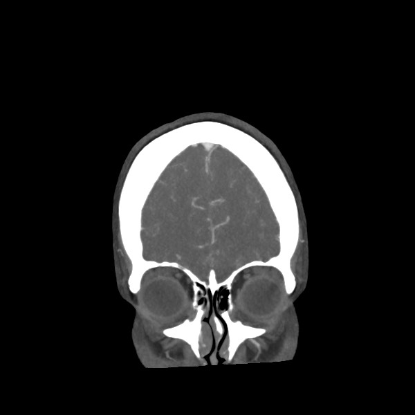 Acute subarachnoid hemorrhage and accessory anterior cerebral artery (Radiopaedia 69231-79009 Coronal C+ arterial phase 16).jpg