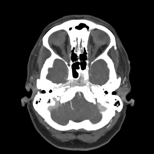 Acute subarachnoid hemorrhage and accessory anterior cerebral artery (Radiopaedia 69231-79009 D 16).jpg