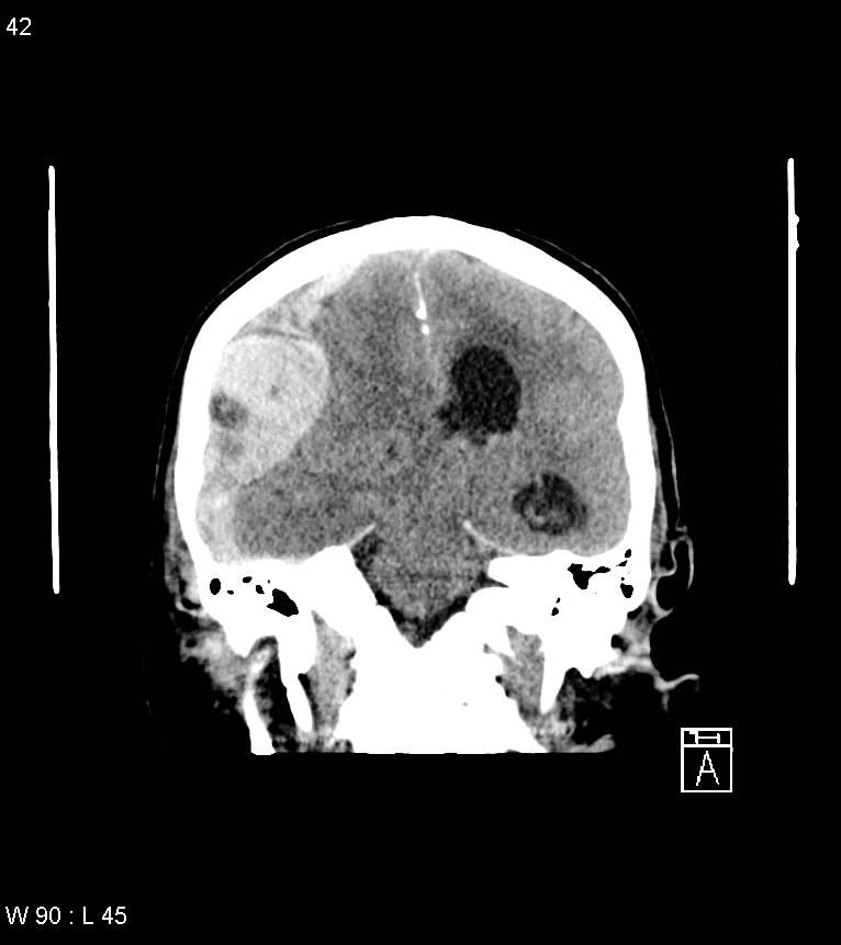Acute subdural hematoma with myelofibrosis (Radiopaedia 52582-58494 Coronal non-contrast 33).jpg