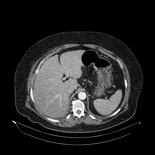 File:Acute superior mesenteric artery occlusion (Radiopaedia 51288-56960 Axial C+ arterial phase 18).jpg