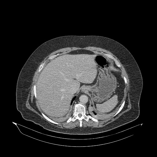 Acute superior mesenteric artery occlusion (Radiopaedia 51288-56960 Axial C+ portal venous phase 16).jpg