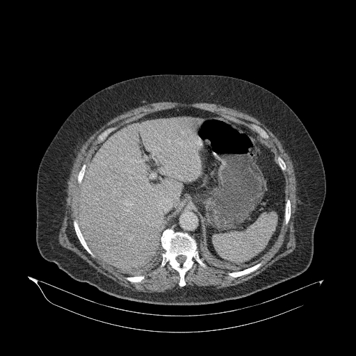 Acute superior mesenteric artery occlusion (Radiopaedia 51288-56960 Axial C+ portal venous phase 21).jpg