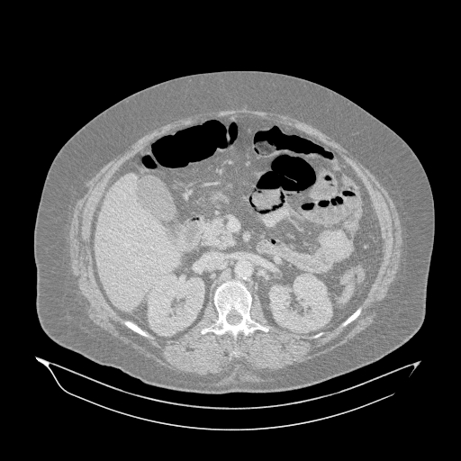 Acute superior mesenteric artery occlusion (Radiopaedia 51288-56960 Axial lung window 17).jpg
