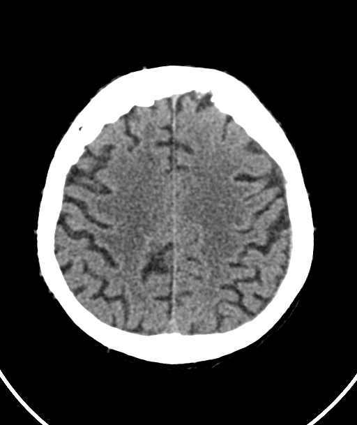 Acute traumatic subdural hematoma (Radiopaedia 82921-97257 Axial non-contrast 22).jpg