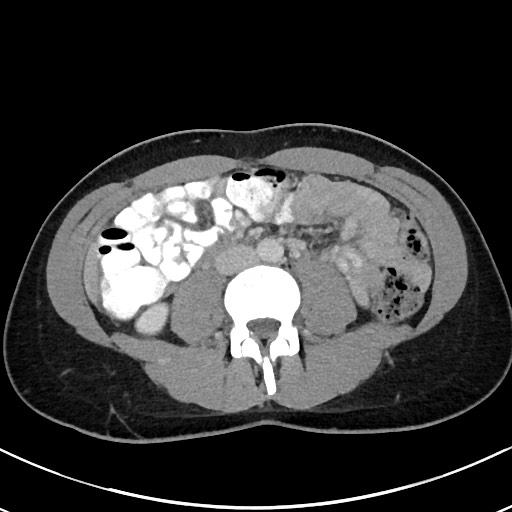 Acute uncomplicated appendicitis (Radiopaedia 61374-69304 Axial C+ portal venous phase 62).jpg