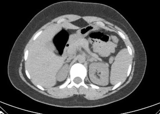Acute unilateral nonhemorrhagic adrenal infarction (Radiopaedia 67560-76957 Axial non-contrast 37).jpg