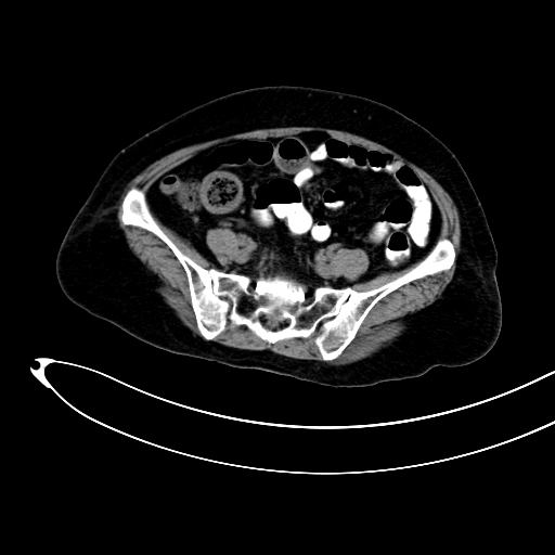 Adenocarcinoma colon with intussusception (Radiopaedia 86006-101922 Axial non-contrast 42).jpg