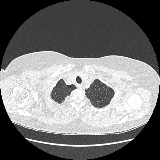 Adenocarcinoma in situ of lung (Radiopaedia 38685-40829 B 25).png