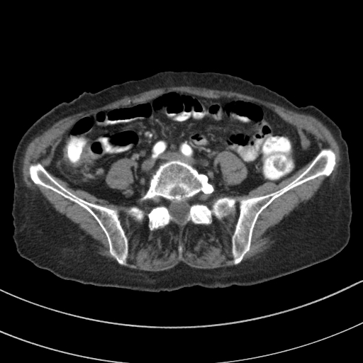 Adenocarcinoma of cecum (Radiopaedia 59222-66549 Axial C+ arterial phase 102).jpg