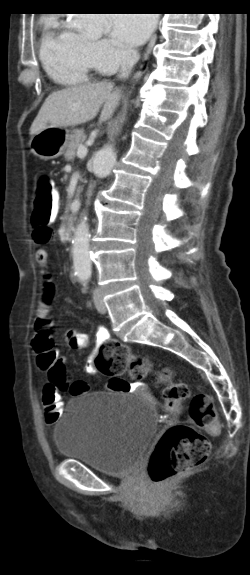Adenocarcinoma of cecum (Radiopaedia 59222-66549 Sagittal C+ portal venous phase 47).jpg