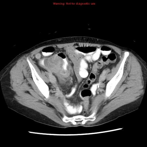 File:Adenocarcinoma of the colon (Radiopaedia 8191-9039 Axial renal excretory phase 48).jpg