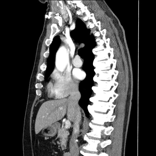 File:Adenocarcinoma of the lung (Radiopaedia 59871-67325 Sagittal C+ arterial phase 45).jpg