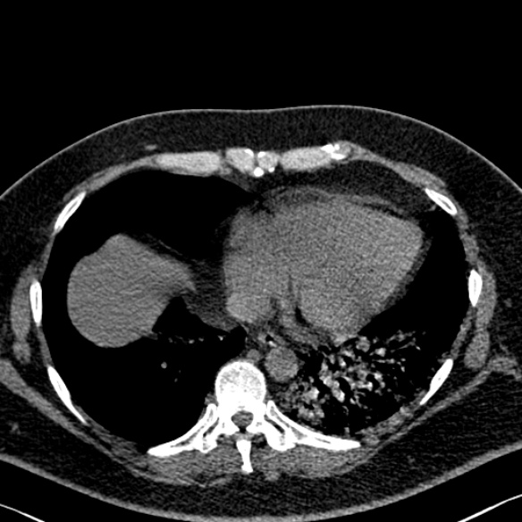 Adenoid cystic carcinoma of the trachea (Radiopaedia 49042-54137 Axial non-contrast 251).jpg