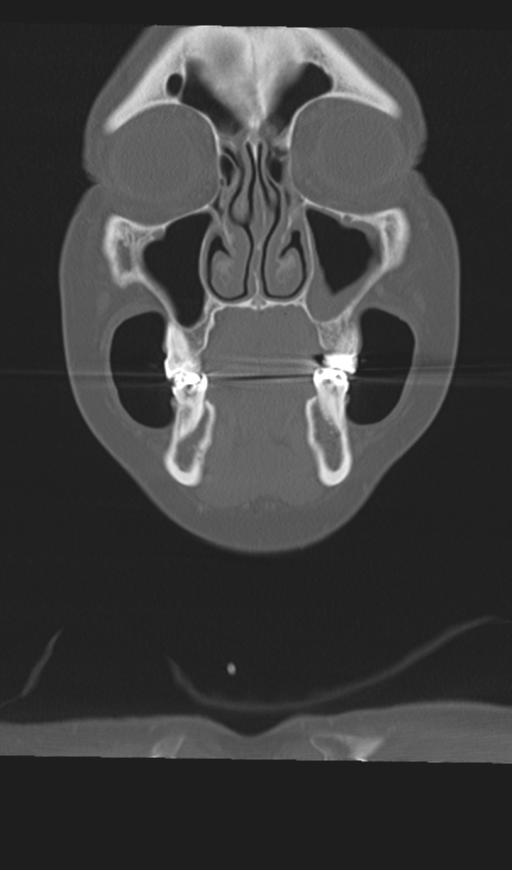 Adenoid cystic tumor of palate (Radiopaedia 46980-51518 Coronal bone window 17).png