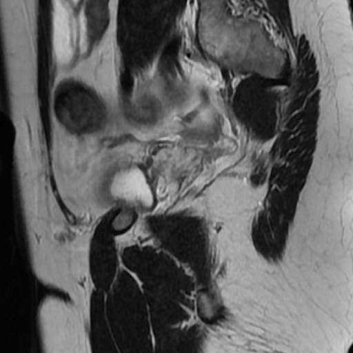 File:Adenoma malignum of cervix (Radiopaedia 66441-75705 Sagittal T2 20).jpg