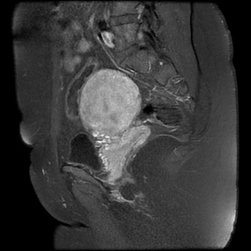 File:Adenomyosis-scar endometriosis (Radiopaedia 65863-75022 Sagittal T1 C+ fat sat 17).jpg
