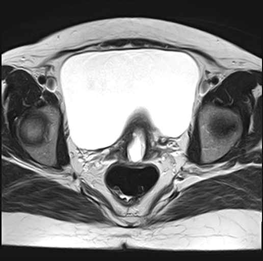 File:Adenomyosis - ovarian endometriomas (Radiopaedia 67031-76350 Axial T2 19).jpg