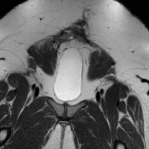 File:Adenomyosis within a didelphys uterus (Radiopaedia 70175-80215 Coronal T2 4).jpg
