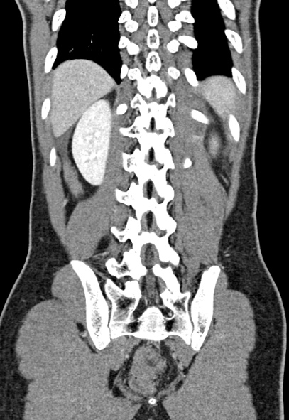Adhesional small bowel obstruction (Radiopaedia 52107-57980 Coronal C+ portal venous phase 66).jpg