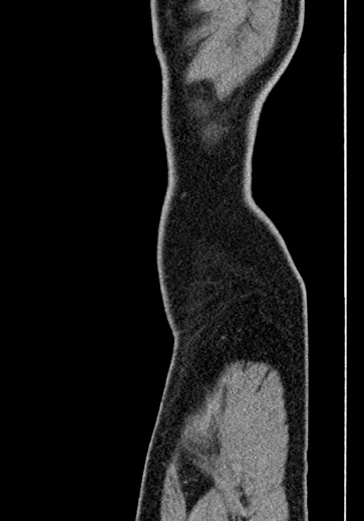 Adhesional small bowel obstruction (Radiopaedia 58900-66131 Sagittal C+ portal venous phase 6).jpg