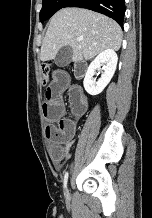 Adhesional small bowel obstruction (Radiopaedia 58900-66131 Sagittal C+ portal venous phase 74).jpg