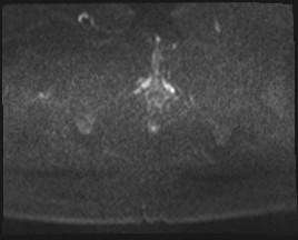 Adnexal multilocular cyst (O-RADS US 3- O-RADS MRI 3) (Radiopaedia 87426-103754 Axial DWI 87).jpg