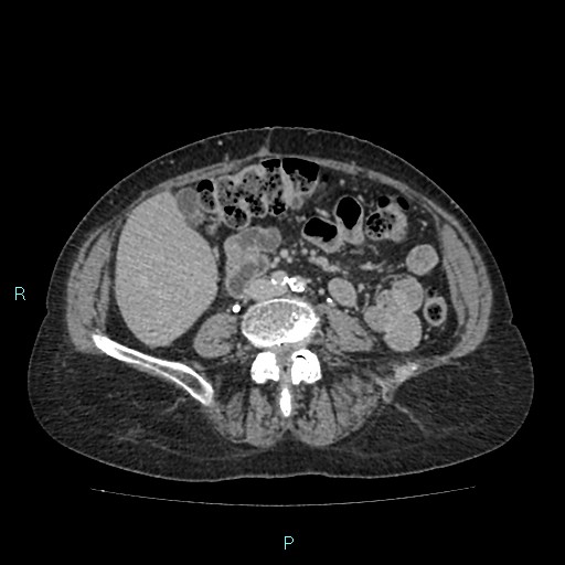 File:Adrenal collision tumor (ACT) (Radiopaedia 48462-53379 Axial C+ delayed 38).jpg