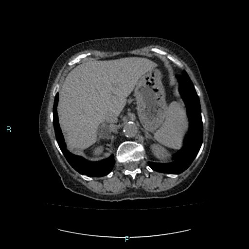 File:Adrenal collision tumor (ACT) (Radiopaedia 48462-53379 Axial non-contrast 11).jpg