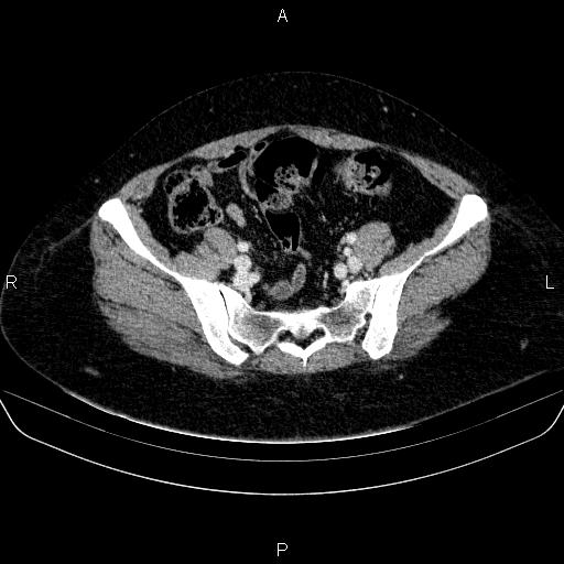 Adrenal cortical carcinoma (Radiopaedia 84882-100379 Axial C+ portal venous phase 74).jpg