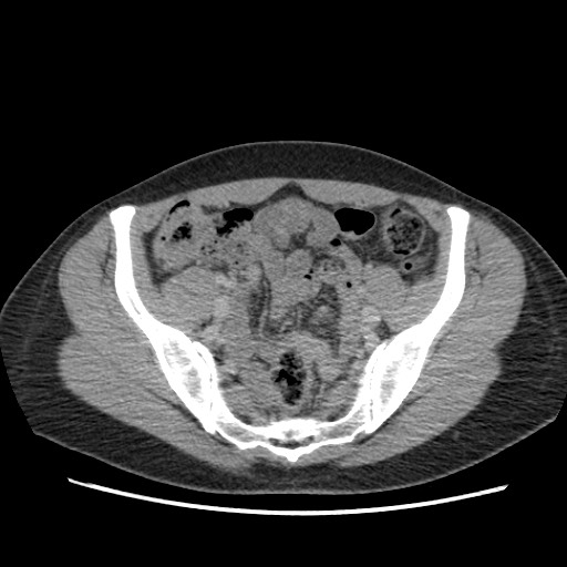 File:Adrenal cyst (Radiopaedia 64869-73813 Axial C+ portal venous phase 62).jpg