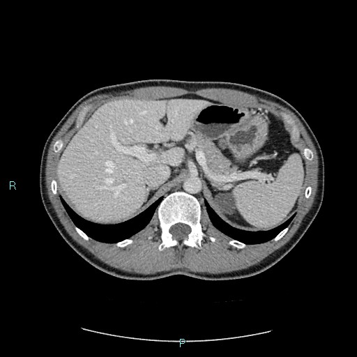 Adrenal cystic lymphangioma (Radiopaedia 83161-97534 Axial C+ portal venous phase 26).jpg