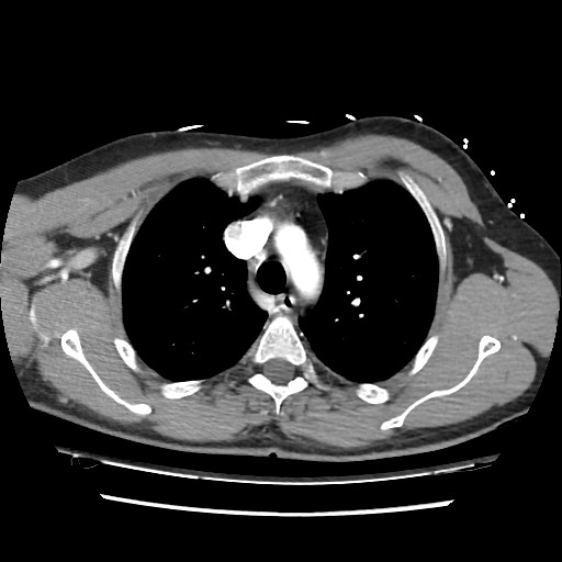 Adrenal gland trauma (Radiopaedia 81351-95078 Axial Dual bolus trauma C+ 23).jpg