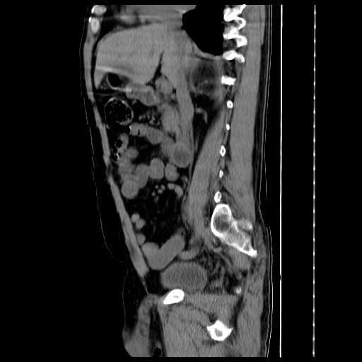 File:Adrenal myelolipoma (Radiopaedia 41843-44834 Sagittal non-contrast 19).jpg