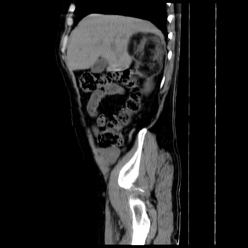 File:Adrenal myelolipoma (Radiopaedia 41843-44834 Sagittal non-contrast 4).jpg