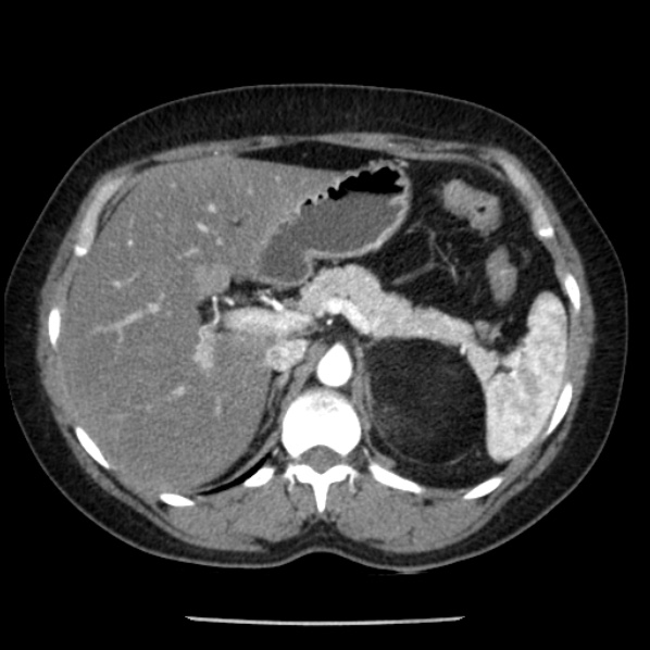 File:Adrenal myelolipoma (Radiopaedia 43401-46759 Axial C+ arterial phase 28).jpg