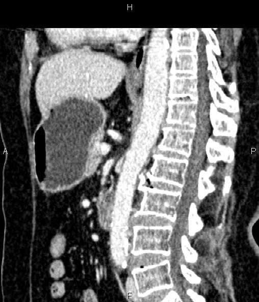 Adrenal myelolipoma (Radiopaedia 82742-96986 Sagittal renal cortical phase 58).jpg