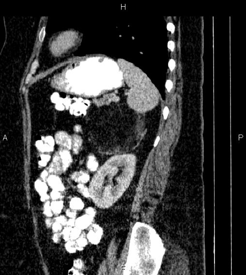 Adrenal myelolipoma (Radiopaedia 84319-99617 Sagittal renal cortical phase 72).jpg