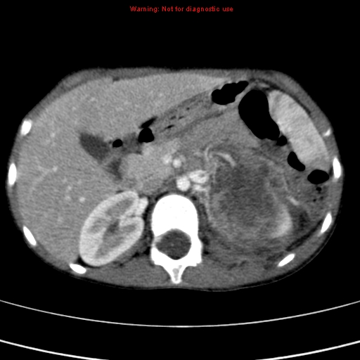 File:Adrenocortical carcinoma (Radiopaedia 9449-10131 Axial C+ portal venous phase 21).jpg