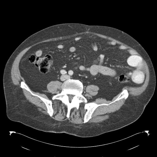 Adult ileal intussusception with secondary obstruction (Radiopaedia 30395-31051 Axial C+ portal venous phase 50).jpg