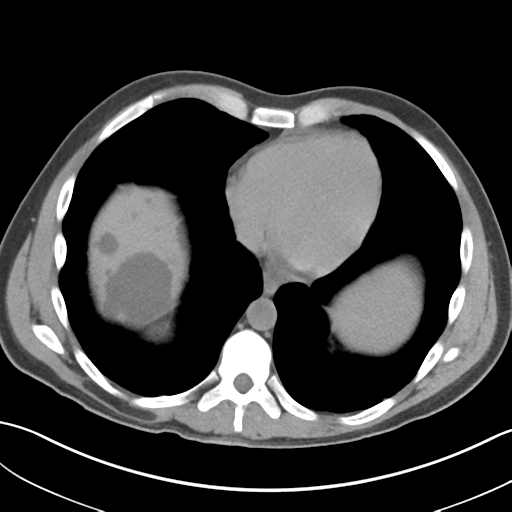 File:Adult polycystic kidney disease (Radiopaedia 47866-52626 Axial non-contrast 4).png