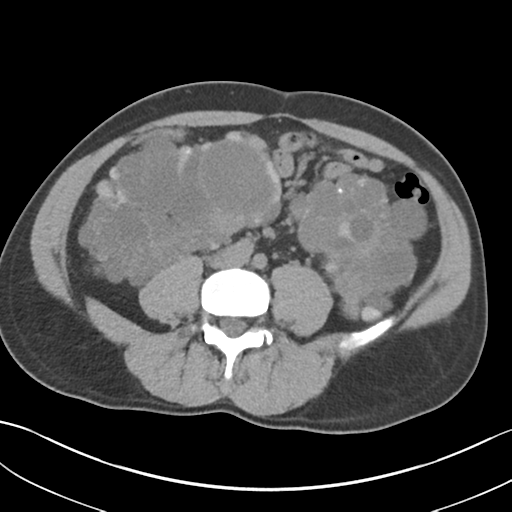 File:Adult polycystic kidney disease (Radiopaedia 47866-52626 Axial non-contrast 48).png