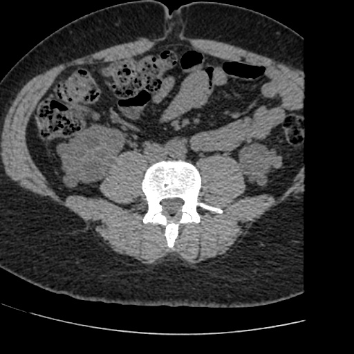Adult polycystic kidney disease (Radiopaedia 59075-66368 Axial non-contrast 54).jpg
