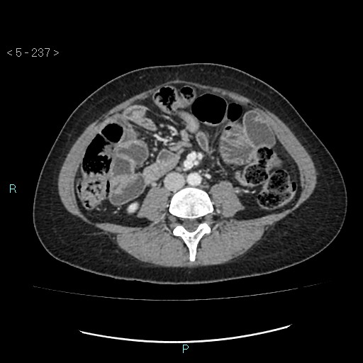 Adult transient intestinal intussusception (Radiopaedia 34853-36310 Axial C+ portal venous phase 48).jpg