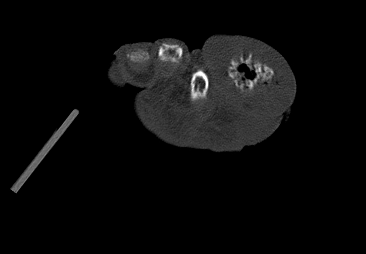 Advanced osteomyelitis due to open metatarsal fracture (Radiopaedia 83891-99095 Axial bone window 49).jpg